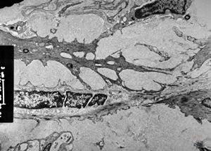 M,60y. | jejunum - amyloidosis M,60y. | jejunum - amyloidosis